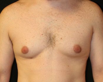 Male Breast Reduction - Before & After - Dr. Placik