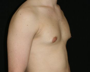 Male Breast Reduction - Before & After - Dr. Placik