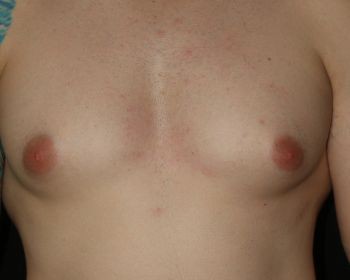 Male Breast Reduction - Before & After - Dr. Placik