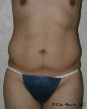 Male Liposuction - Before & After - Dr. Placik