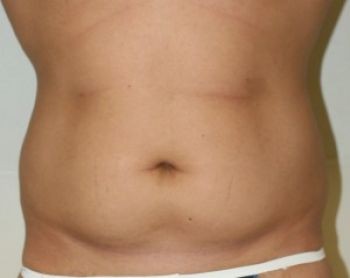 Male Liposuction - Before & After - Dr. Placik