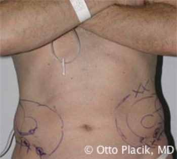 Male Liposuction - Before & After - Dr. Placik