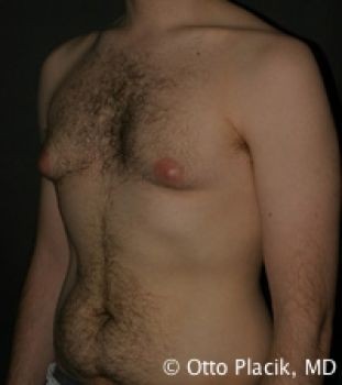 Male Liposuction - Before & After - Dr. Placik