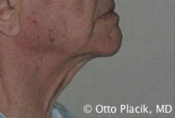 Male Neck Lift - Before & After - Dr. Placik