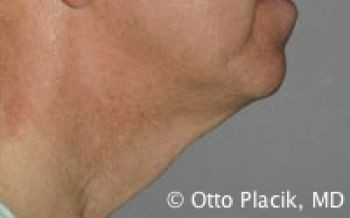 Male Neck Lift - Before & After - Dr. Placik