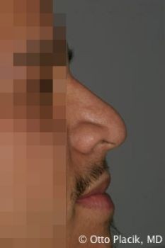 Male Rhinoplasty - Before & After - Dr. Placik