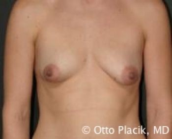 Before & After Breast Augmentation Gallery - Before & After - Dr. Placik