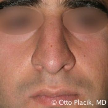 Male Rhinoplasty in Chicago