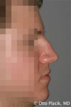 Male Rhinoplasty - Before & After - Dr. Placik