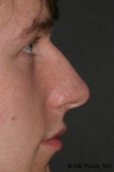 Male Rhinoplasty - Before & After - Dr. Placik