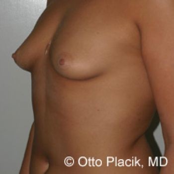 Before & After Breast Augmentation Gallery - Before & After - Dr. Placik