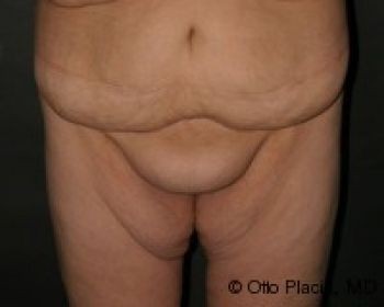 Mons Pubis Reduction - Before & After - Dr. Placik