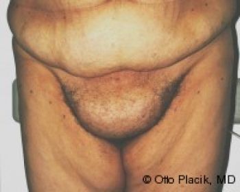 Mons Pubis Reduction - Before & After - Dr. Placik