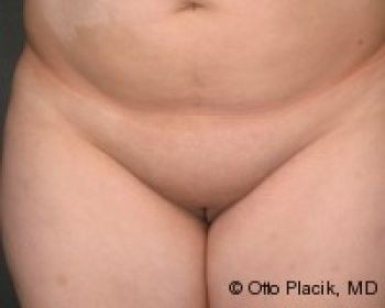 Mons Pubis Reduction - Before & After - Dr. Placik