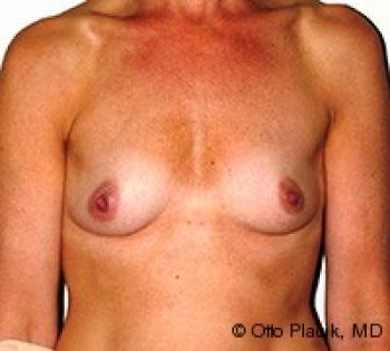 Before & After Breast Augmentation Gallery - Before & After - Dr. Placik