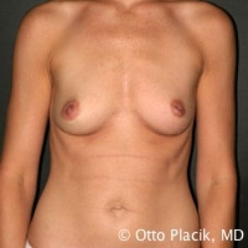 Before & After Breast Augmentation Gallery - Before & After - Dr. Placik