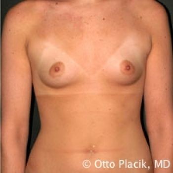 Before & After Breast Augmentation Gallery - Before & After - Dr. Placik