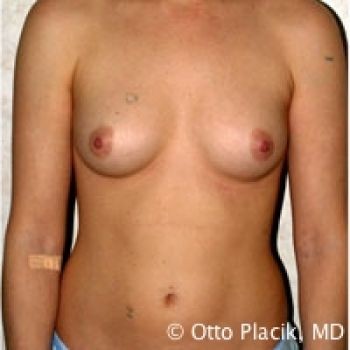 Before & After Breast Augmentation Gallery - Before & After - Dr. Placik