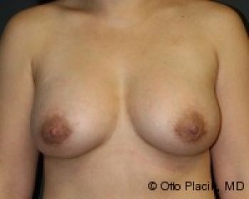 Before & After Breast Augmentation Gallery - Before & After - Dr. Placik