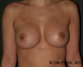 Before & After Breast Augmentation Gallery - Before & After - Dr. Placik