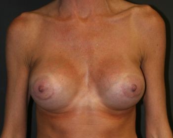 Before & After Breast Augmentation Gallery - Before & After - Dr. Placik