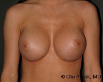 Before & After Breast Augmentation Gallery - Before & After - Dr. Placik