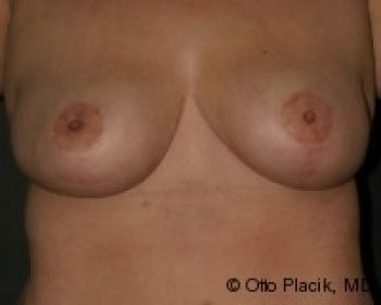 Breast Reduction - Before & After - Dr. Placik