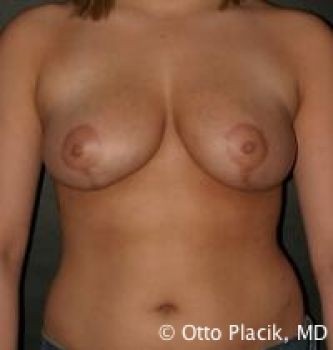 Breast Reduction - Before & After - Dr. Placik