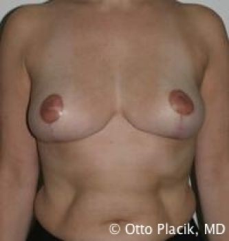 Breast Reduction - Before & After - Dr. Placik