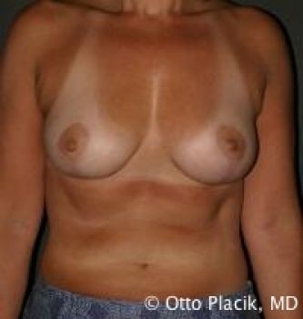 Breast Reduction - Before & After - Dr. Placik