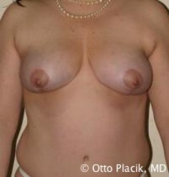 Breast Reduction - Before & After - Dr. Placik