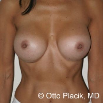 Before & After Breast Augmentation Gallery - Before & After - Dr. Placik