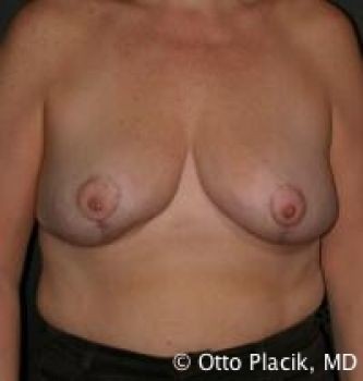 Breast Reduction - Before & After - Dr. Placik