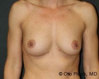 Breast Augmentation with Fat Grafting - Before & After - Dr. Placik