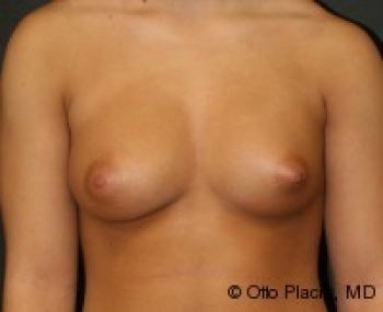 Breast Augmentation with Fat Grafting - Before & After - Dr. Placik