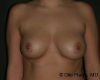 Breast Augmentation with Fat Grafting - Before & After - Dr. Placik