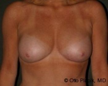 Breast Augmentation with Fat Grafting - Before & After - Dr. Placik