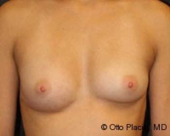 Breast Augmentation with Fat Grafting - Before & After - Dr. Placik