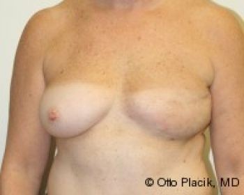 Breast Augmentation with Fat Grafting - Before & After - Dr. Placik