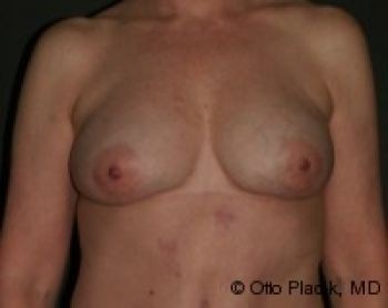 Breast Augmentation with Fat Grafting - Before & After - Dr. Placik