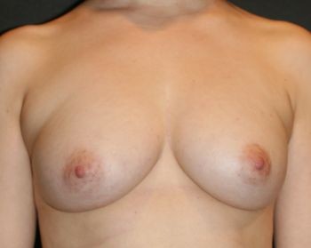 Breast Augmentation with Fat Grafting - Before & After - Dr. Placik