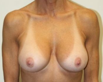 Breast Revision - Before & After - Dr. Placik