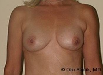 Breast Revision - Before & After - Dr. Placik