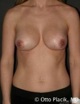 Breast Revision - Before & After - Dr. Placik