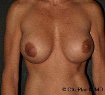 Breast Revision - Before & After - Dr. Placik