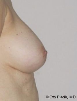 Nipple Reduction - Before & After - Dr. Placik