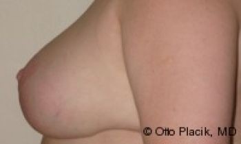 Nipple Reduction - Before & After - Dr. Placik