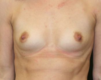 Nipple Reduction - Before & After - Dr. Placik