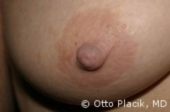 Nipple Repair - Before & After - Dr. Placik