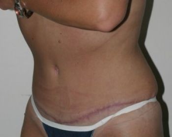 Tummy Tuck - Before & After - Dr. Placik